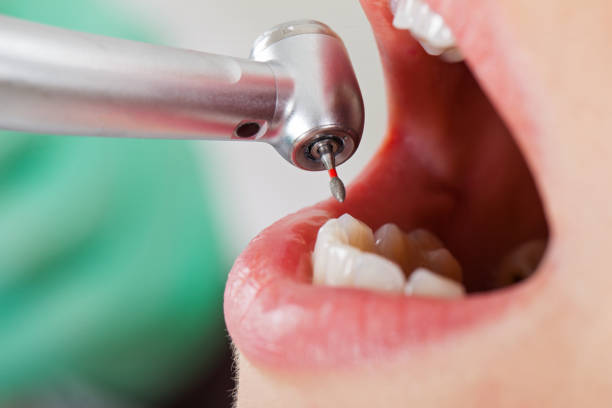 Best Emergency Dental Care for Broken or Chipped Teeth in Great Bend, NY